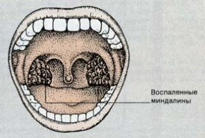 чем лечить горло ребенку 8 лет